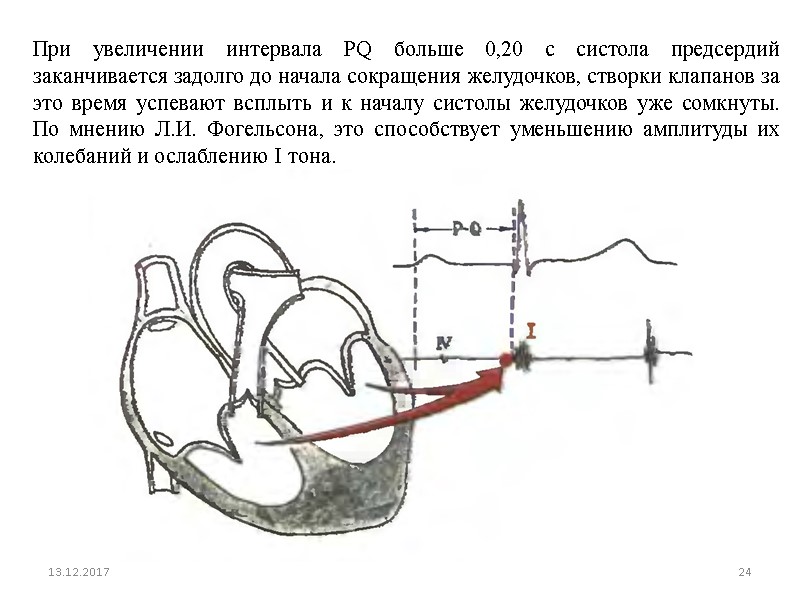 13.12.2017 24 При увеличении интервала PQ больше 0,20 с систола предсердий заканчивается задолго до